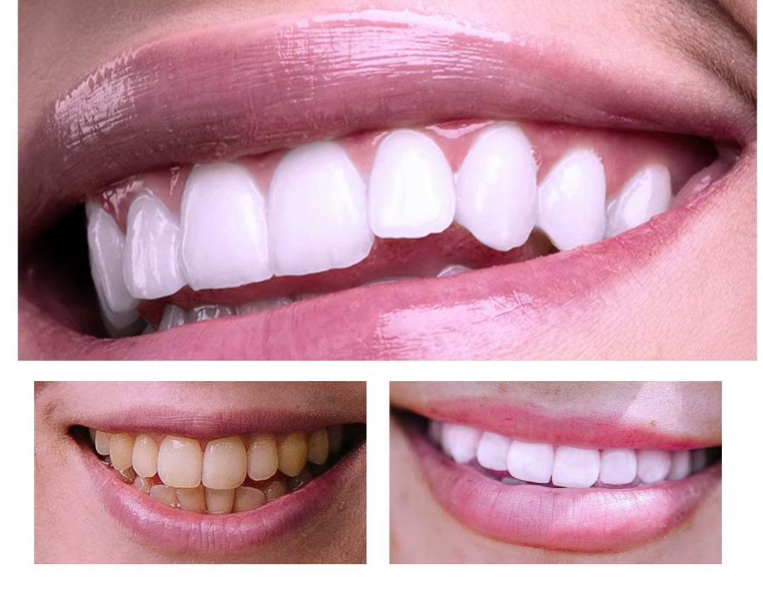 Mousse de Blanchiment des Dents V34 de LANTHOME !