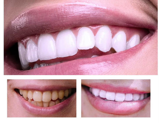 Mousse de Blanchiment des Dents V34 de LANTHOME !